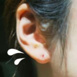 【体験談】旅行中にピアスで出血…原因は金属アレルギー？使い方？