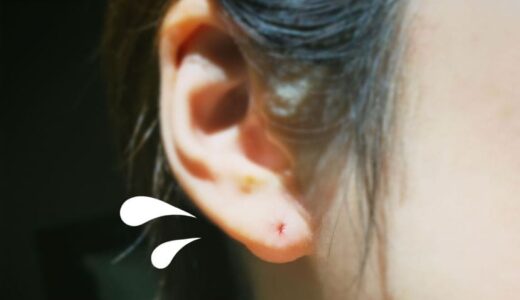 【体験談】旅行中にピアスで出血…原因は金属アレルギー？使い方？